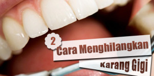 mengilangkan karang gigi